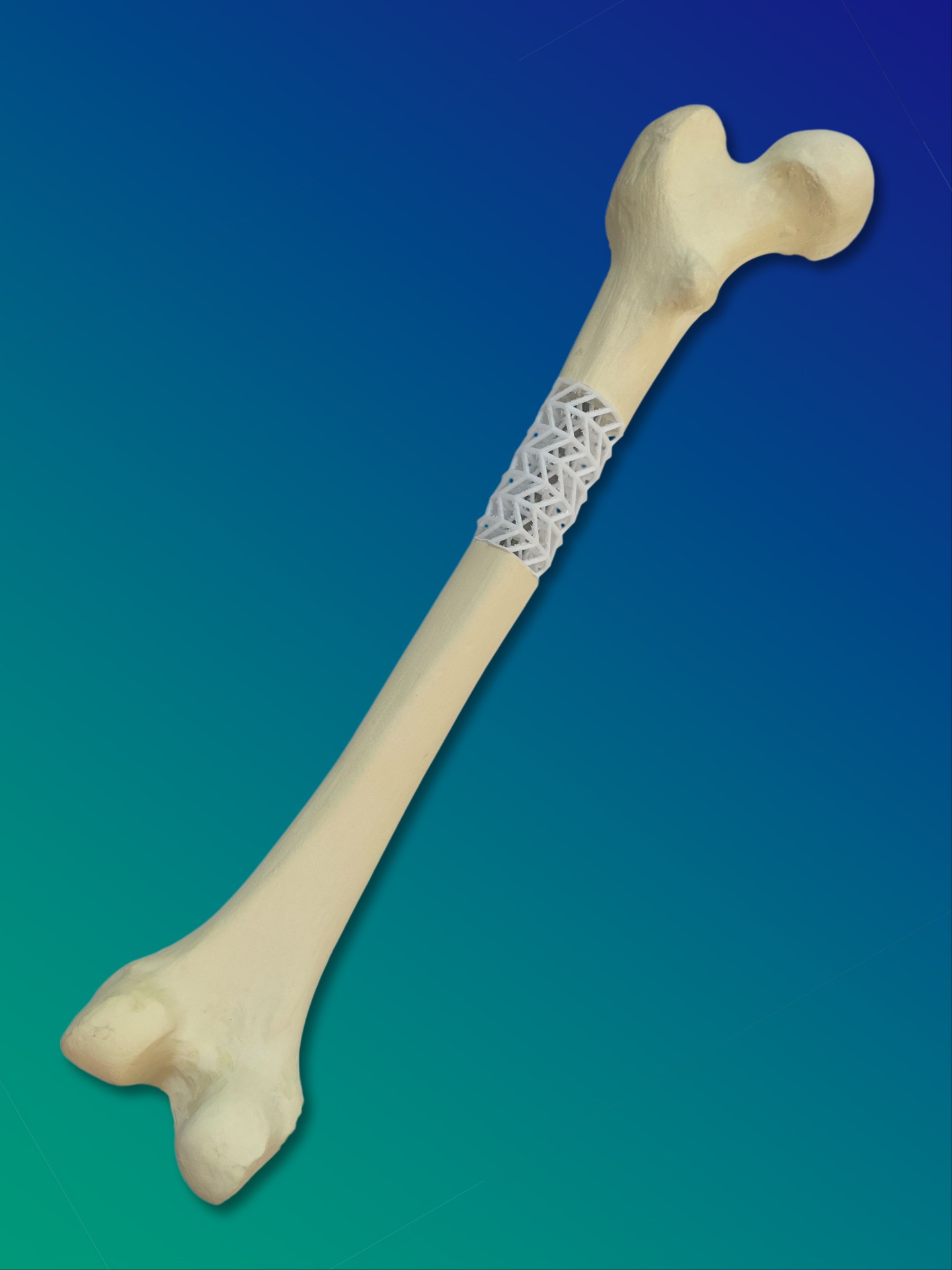 The SCABAEGO project scaffold can be customized to fit any size of long bone. With the help of a CT scan of the bone, the scaffold can be tailor-made using 3D printing.